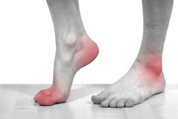 Các cơn đau gout thường xuất hiện nhiều ở các khớp chân