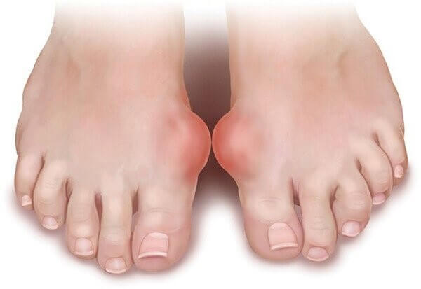 Chân bị sưng đau là biểu hiện của bệnh gout