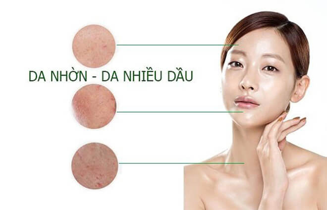 Da dầu nhờn dễ gây mụn