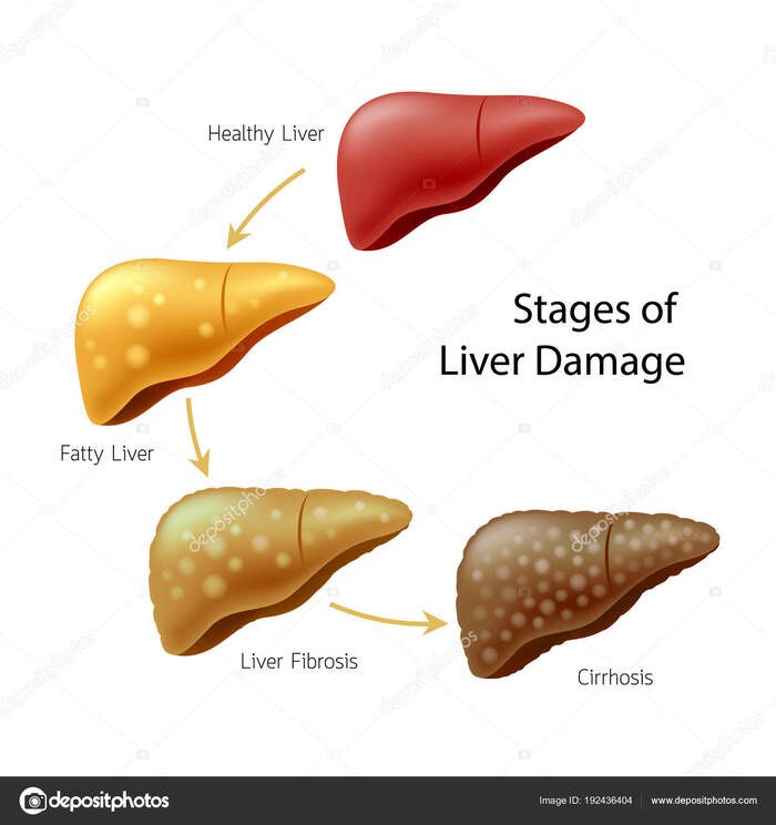 Các giai đoạn chuyển biến của bệnh gan.
