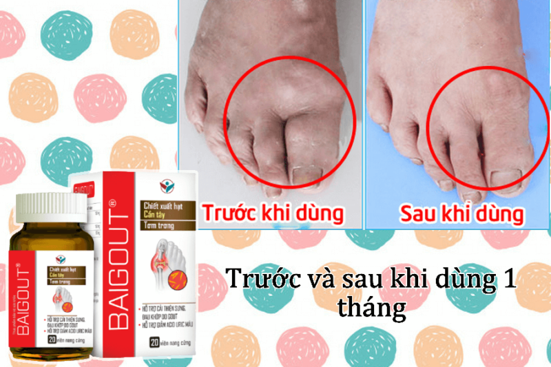 Hiệu quả sau 1 tháng sử dụng Baigout của bản thân mình