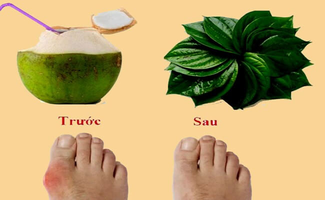 Kết hợp nước dừa với lá trầu không giúp cải thiện các triệu chứng của gout