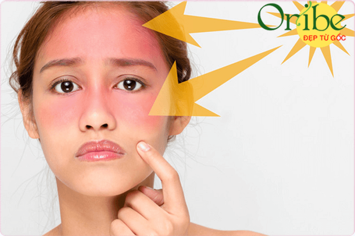 Lựa chọn kem chống nắng không phù hợp dễ gây dị ứng cho da