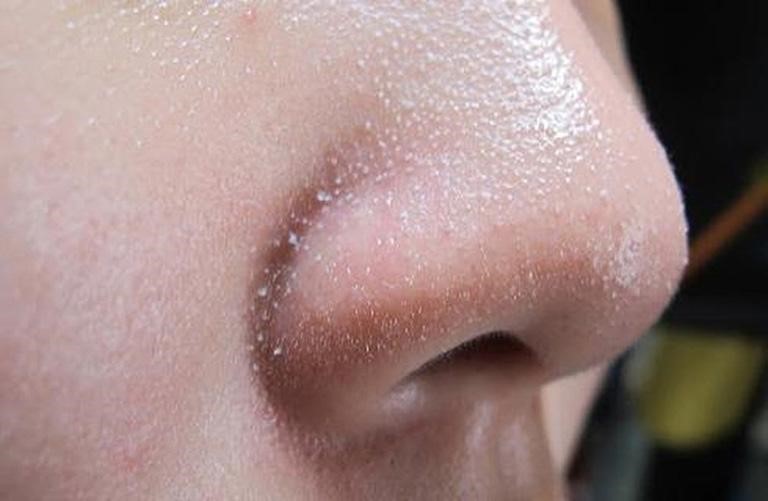 Mụn cám không khó loại bỏ và dễ biến mất nhờ có kem trị mụn cám