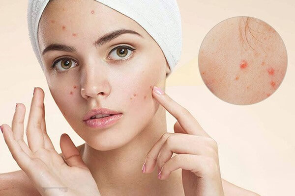 Mụn là tình trạng phổ biến hiện nay